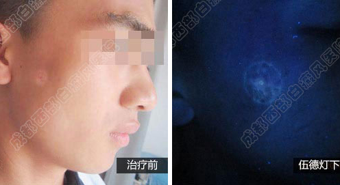 成都白癜风哪个医院好