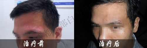 成都白癜风哪个医院好