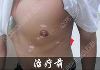 成都白癜风最好的医院是哪个