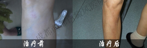 成都白癜风哪个医院好