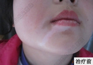 成都白癜风哪个医院好