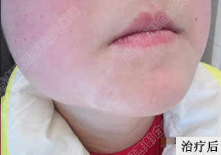 成都白癜风最好的医院是哪个