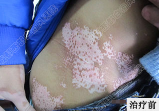 成都白癜风哪个医院好