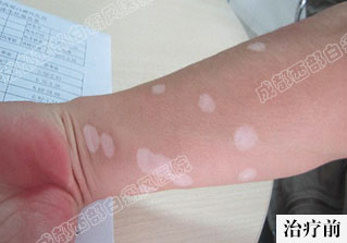 成都白癜风哪个医院好