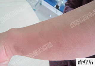 成都白癜风最好的医院是哪个