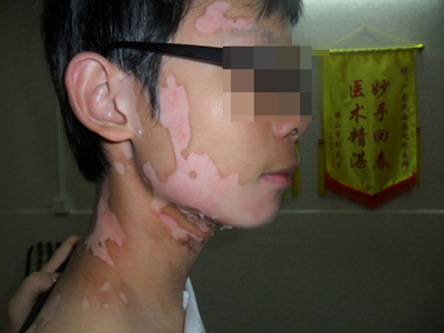 成都白癜风哪个医院好